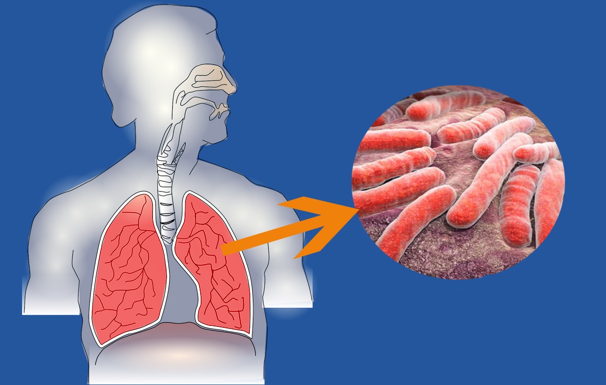 Интересные факты о туберкулезе
